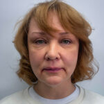 Эндоскопический лифтинг с блефаропластикой - после