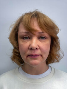 Эндоскопический лифтинг с блефаропластикой - после