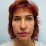 Круговая блефаропластика - после