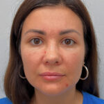 Круговая блефаропластика - после