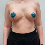 Маммопластика подтяжка - после