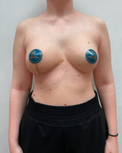 Маммопластика подтяжка - после