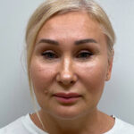 СМАС лифтинг - после