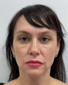 Верхняя блефаропластика - после