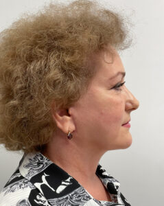 СМАС лифтинг - после