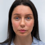 Эндоскопический лифтинг с блефаропластикой - после