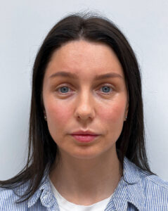 Эндоскопический лифтинг с блефаропластикой - после