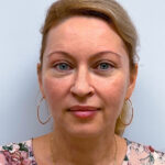 Эндоскопический лифтинг с блефаропластикой - после