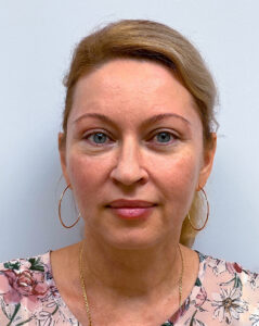 Эндоскопический лифтинг с блефаропластикой - после