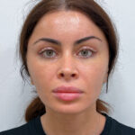 Эндоскопический лифтинг с блефаропластикой - после