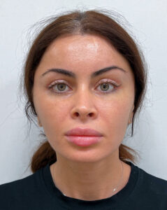 Эндоскопический лифтинг с блефаропластикой - после