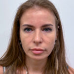 Верхняя блефаропластика - после