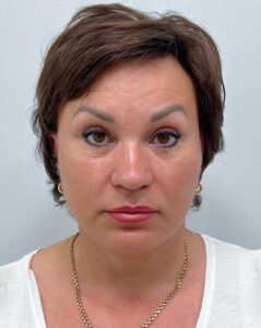 Смас с круговой блефаропластикой - после