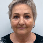 Круговая блефаропластика - после