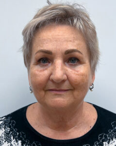 Круговая блефаропластика - после