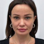 Блефаропластика и эндоскопический лифтинг - после