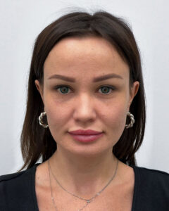 Блефаропластика и эндоскопический лифтинг - после