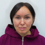 Блефаропластика и эндоскопический лифтинг - после