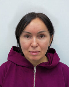 Блефаропластика и эндоскопический лифтинг - после