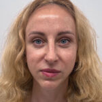 Блефаропластика и эндоскопический лифтинг - после