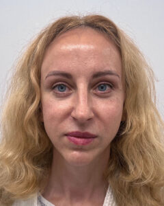 Блефаропластика и эндоскопический лифтинг - после