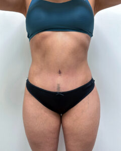 Абдоминопластика - после