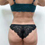 Липосакция - после