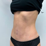 Абдоминопластика - после