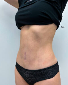 Абдоминопластика - после