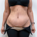 Абдоминопластика - после
