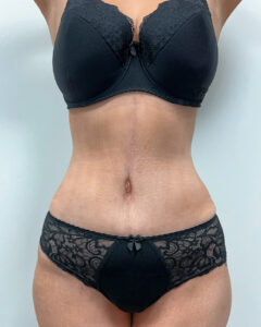 Абдоминопластика - после