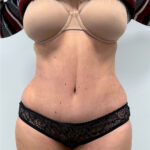 Абдоминопластика - после