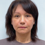 СМАС лифтинг - после