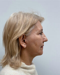 СМАС лифтинг - после