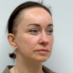 Тотальное омоложение - после