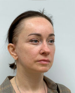 Тотальное омоложение - после