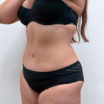 Липосакция - после