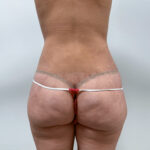 Липосакция - после