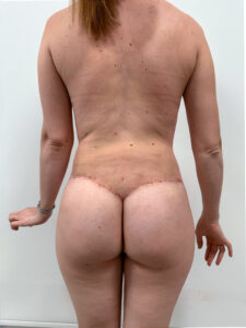 Липосакция - после