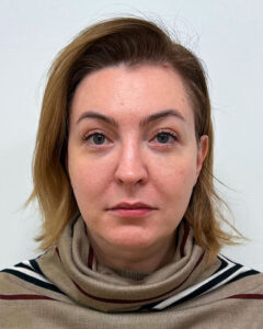 Блефаропластика и эндоскопический лифтинг - после