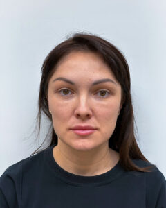 Блефаропластика и эндоскопический лифтинг - после