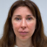 Верхняя блефаропластика с эндоскопическим лифтингом - после