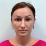 Верхняя блефаропластика с эндоскопическим лифтингом - после