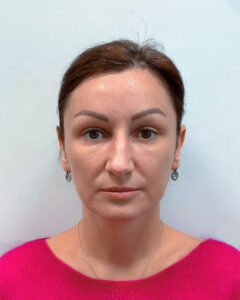 Верхняя блефаропластика с эндоскопическим лифтингом - после