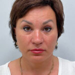 Эндоскопический лифтинг с круговой блефаропластикой - после