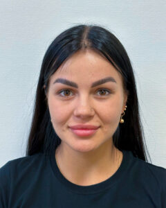 Круговая блефаропластика с эндоскопическим лифтингом - после