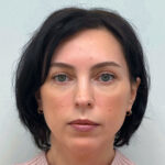 Трансконъюнктивальная блефаропластика - после