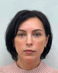 Трансконъюнктивальная блефаропластика - после