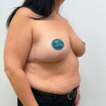 Редукционная маммопластика - после