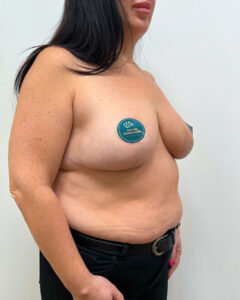 Редукционная маммопластика - после